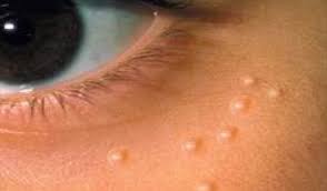 images 29 Skin Tags Home Remedies
