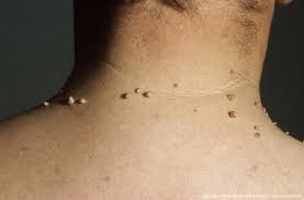 images Skin Tags Home Remedies