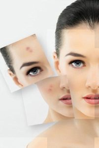 OEM Acne Removing and Anti Acne Cream.jpg 350x350 201x300 Beauty Benefits Of Honey